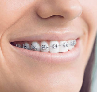 Metal Braces