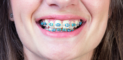 clear braces with purple bands