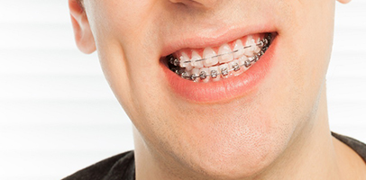 Traditional Braces