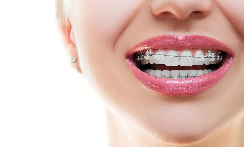 What Happens To Your Teeth When You Get Braces